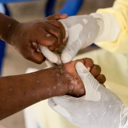 Niassa volta a registar casos de “Mpox”